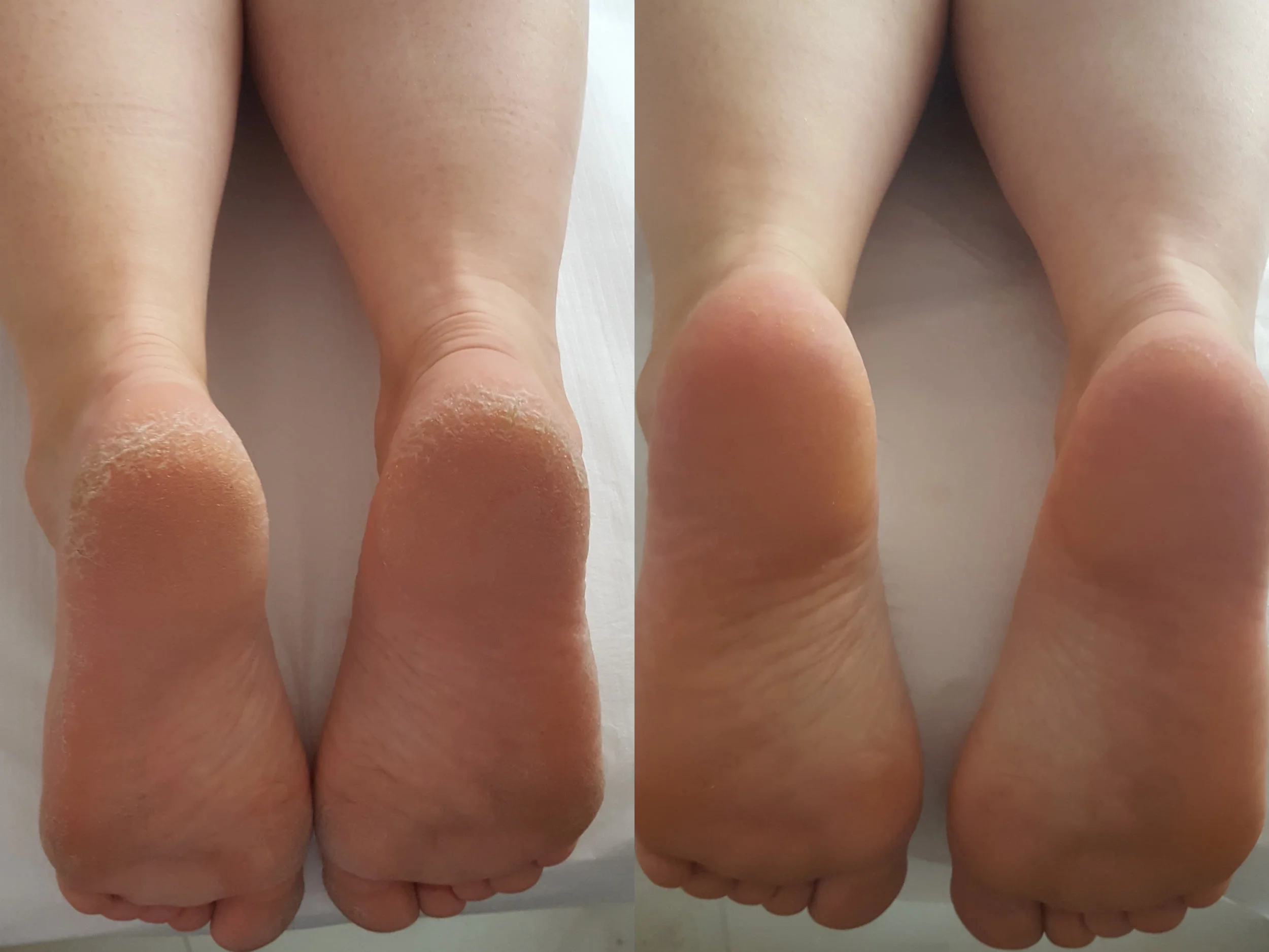 Usunięcie zrogowaciałego naskórka