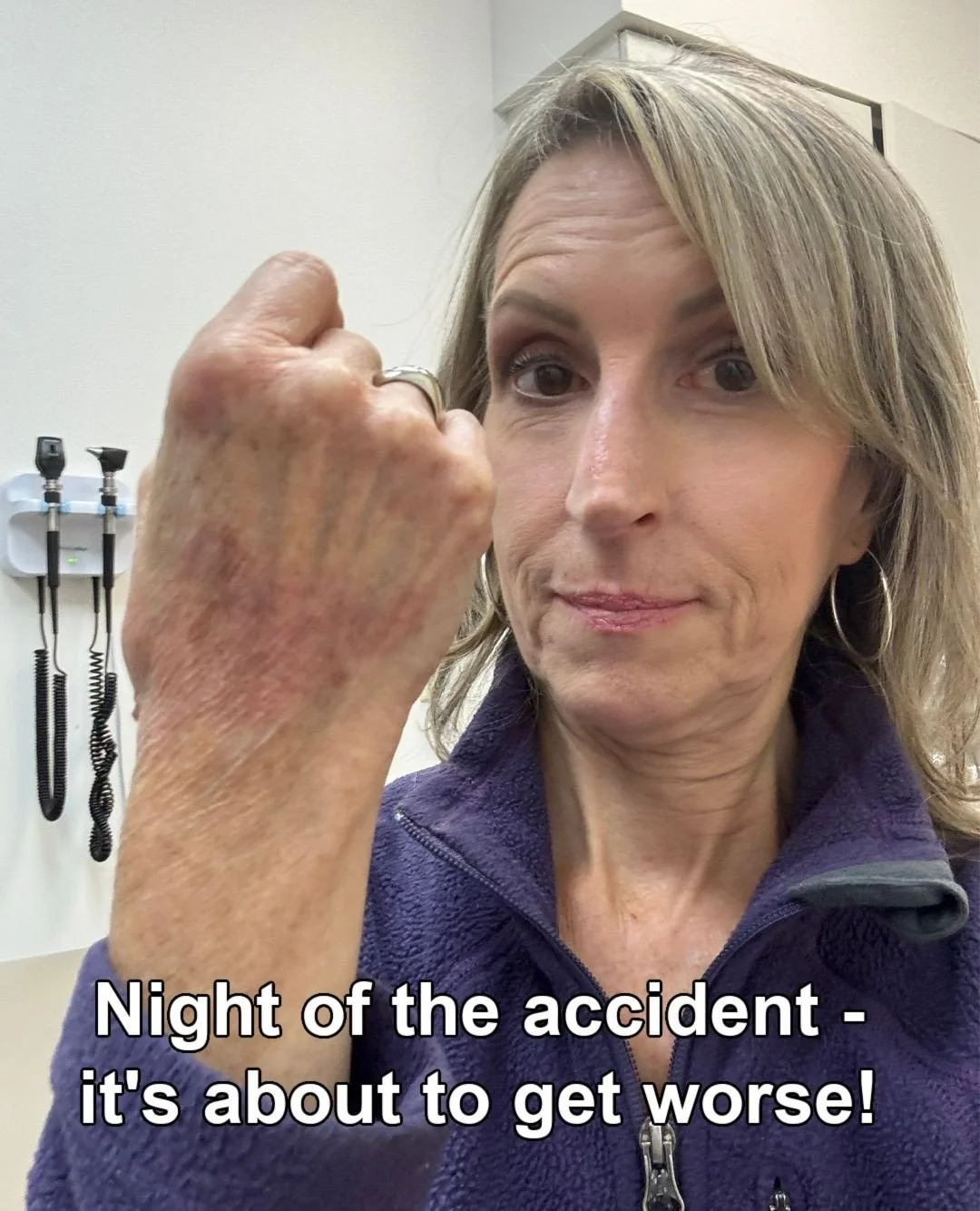 My hand is finally healed from the burn I got from a car accident in November (which happened from the air bag). In the first photo in the carousel, that was taken at urgent care when my hand didn't look too bad, but I could feel the burn.⁠
⁠
They ga