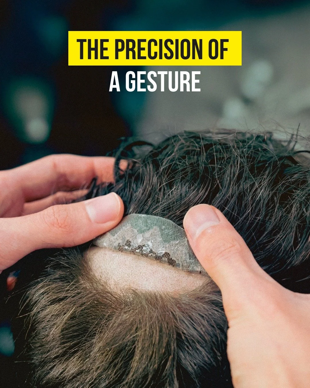 ✨ With the expertise of our specialists, your Hairskeen hair system becomes completely undetectable — delivering an ultra-natural result that blends seamlessly with your own hair.
We make the world’s best hair systems, trusted by over 60