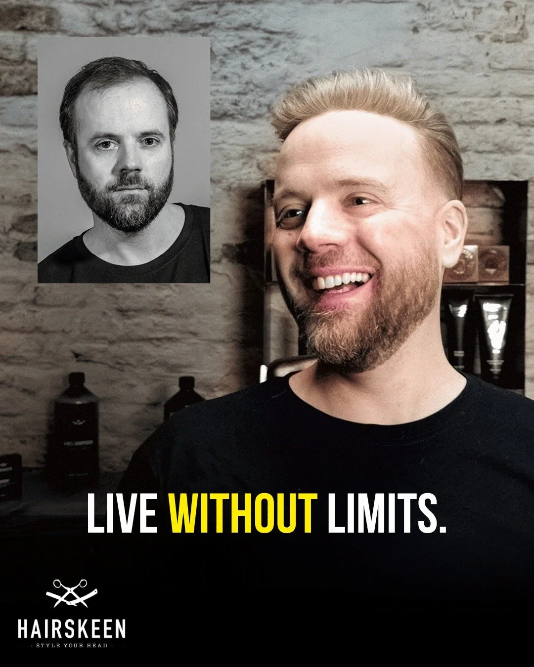 “Before Hairskeen, I did everything I could to hide my hair loss. Today, I finally look at myself with pride.”
Like Édouard, many men spend years avoiding mirrors, cameras, or even spontaneous nights out. Losing your hair can feel