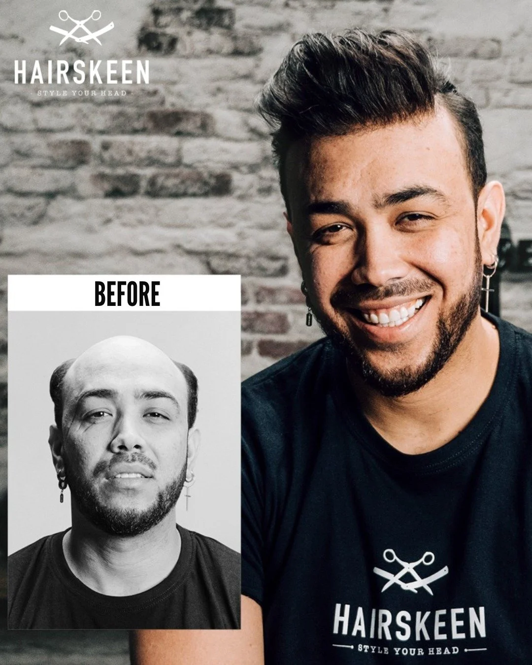 ✨ With his Hairskeen hair system, Tony has broken free from the stigma of hair loss. He took the step into hair replacement – a fast, natural, and effortless way to bring back not only his hair, but also his confidence.
We make the world&rsquo
