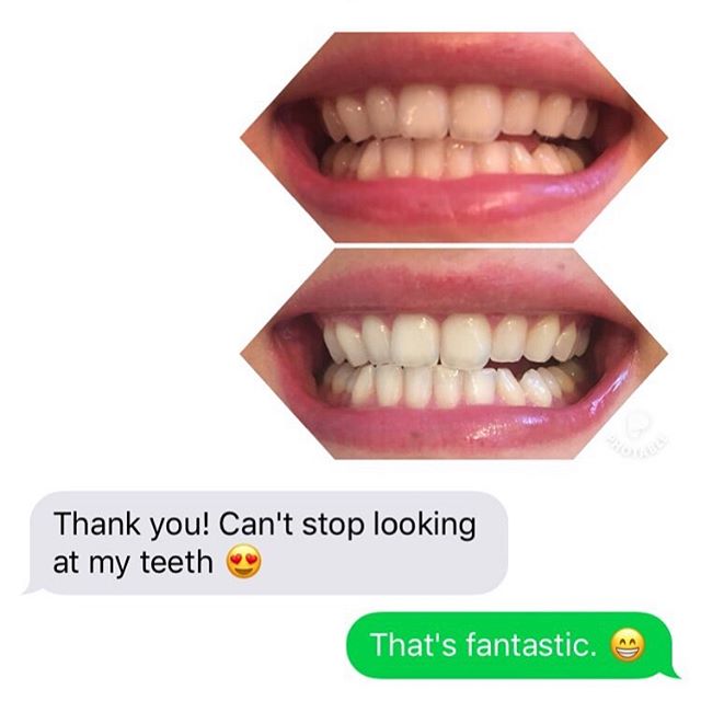This is the reaction of my customer after just one treatment. Sensitivity Free. Enamel Safe. 4 shades whiter @sunna.smile and only 95 taxes in. #enamelsafewhitening #sensitivityfree #teethwhitening #naturalingredients #lovemysmile
