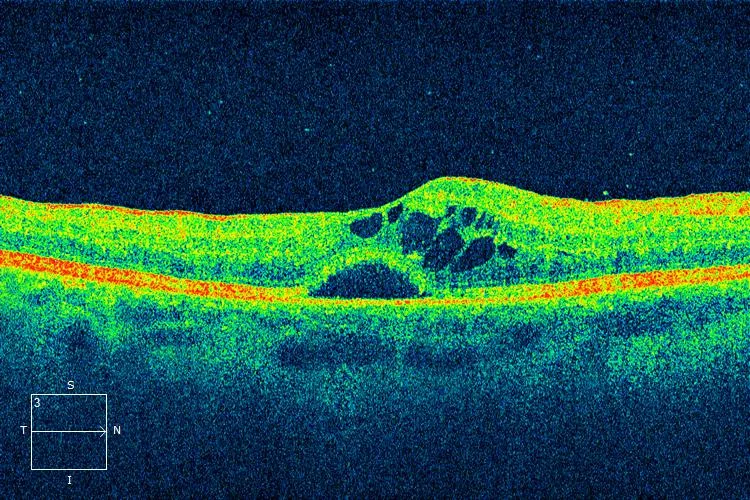 OCT image macular edema