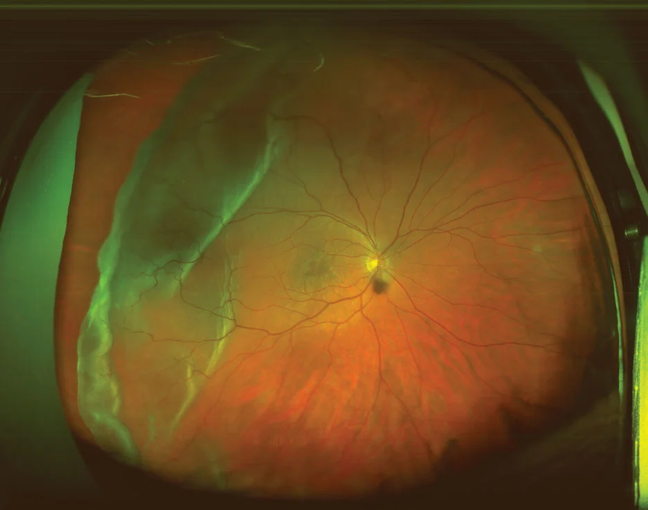 Optomap image retinal detachment