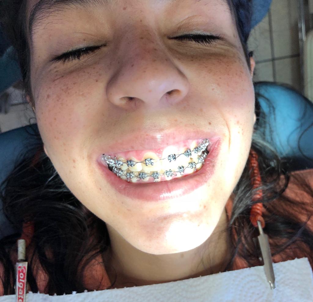 Tratamiento de ortodoncia recién terminado