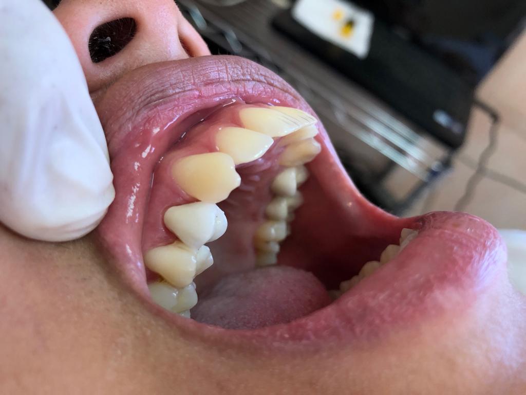 Tratamiento de ortodoncia terminado