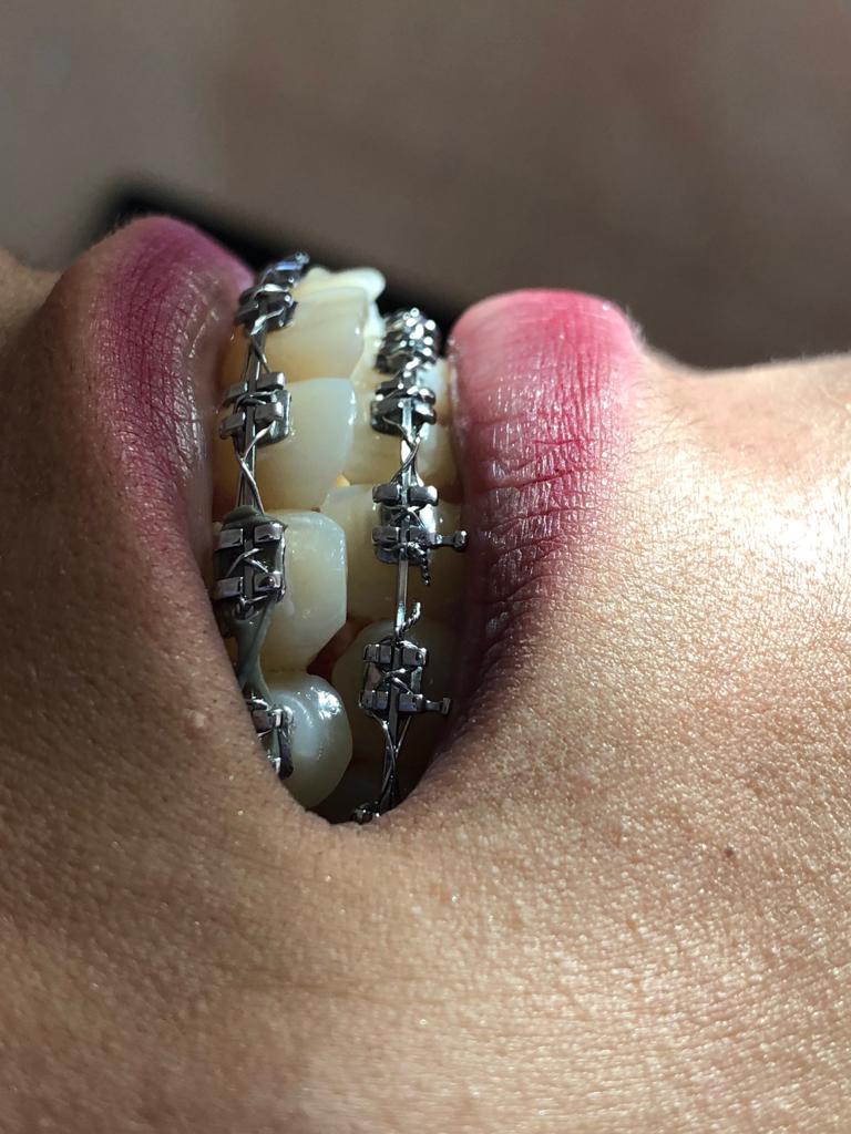 Tratamiento de ortodoncia terminado