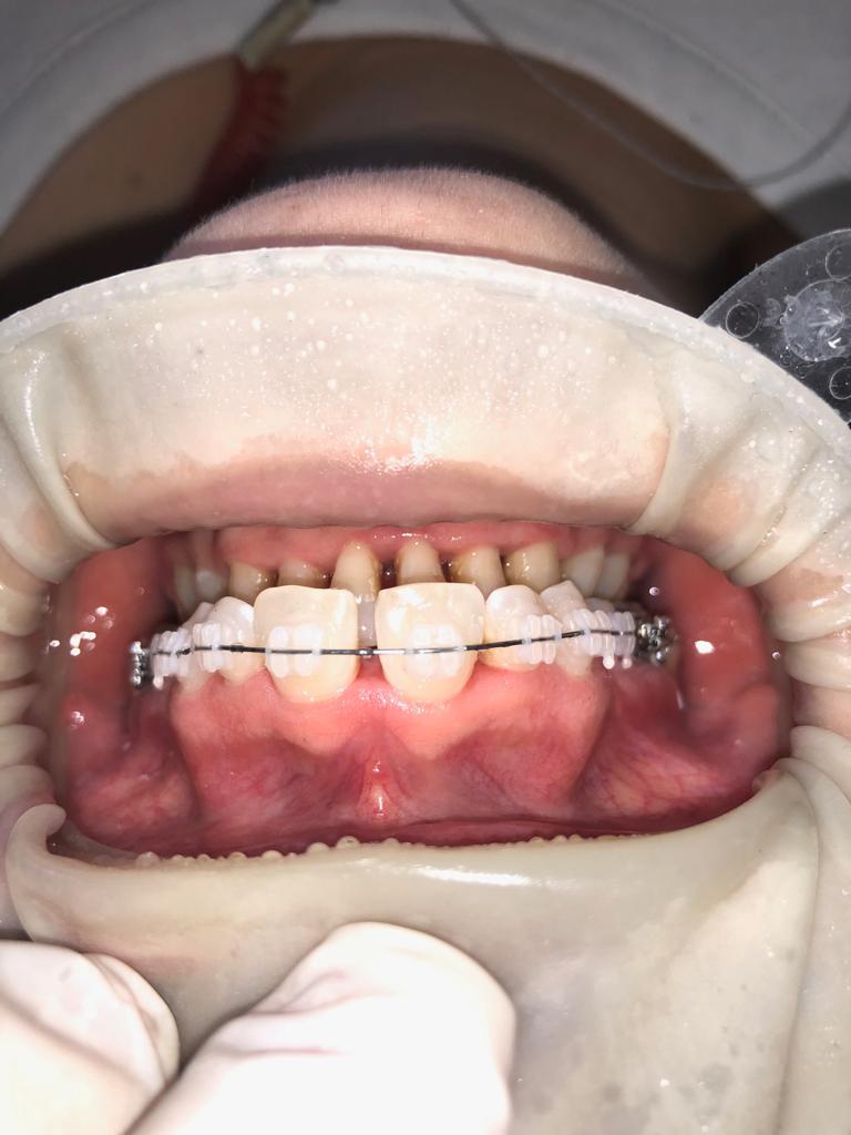Ortodoncia Transparente