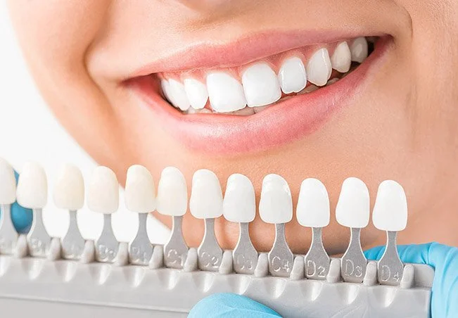 imagen de una escala de blanqueamiento dental comparando los tonos con los resultados de un paciente.