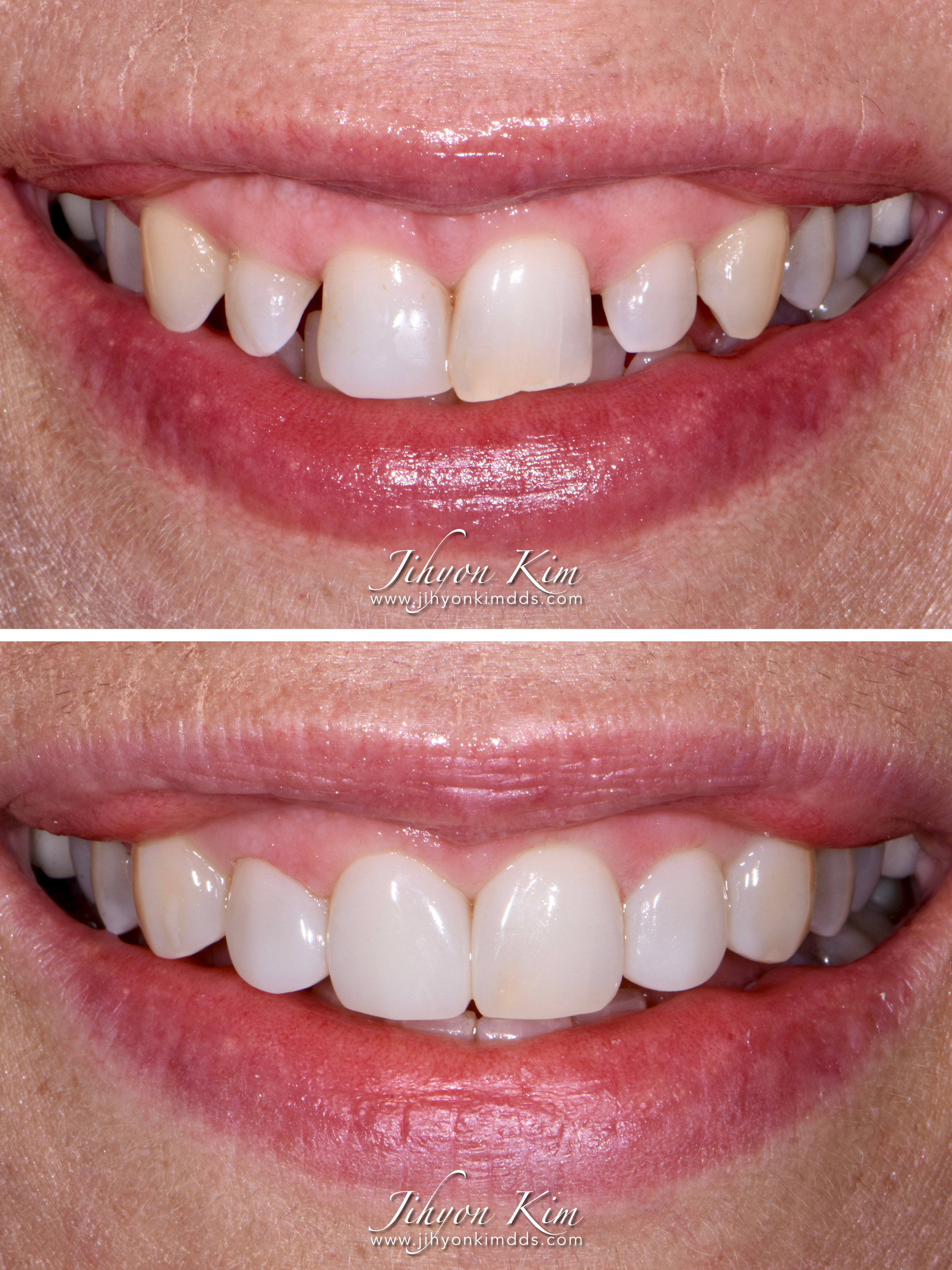 Undersized Dentition, Supraeruption, and Wear