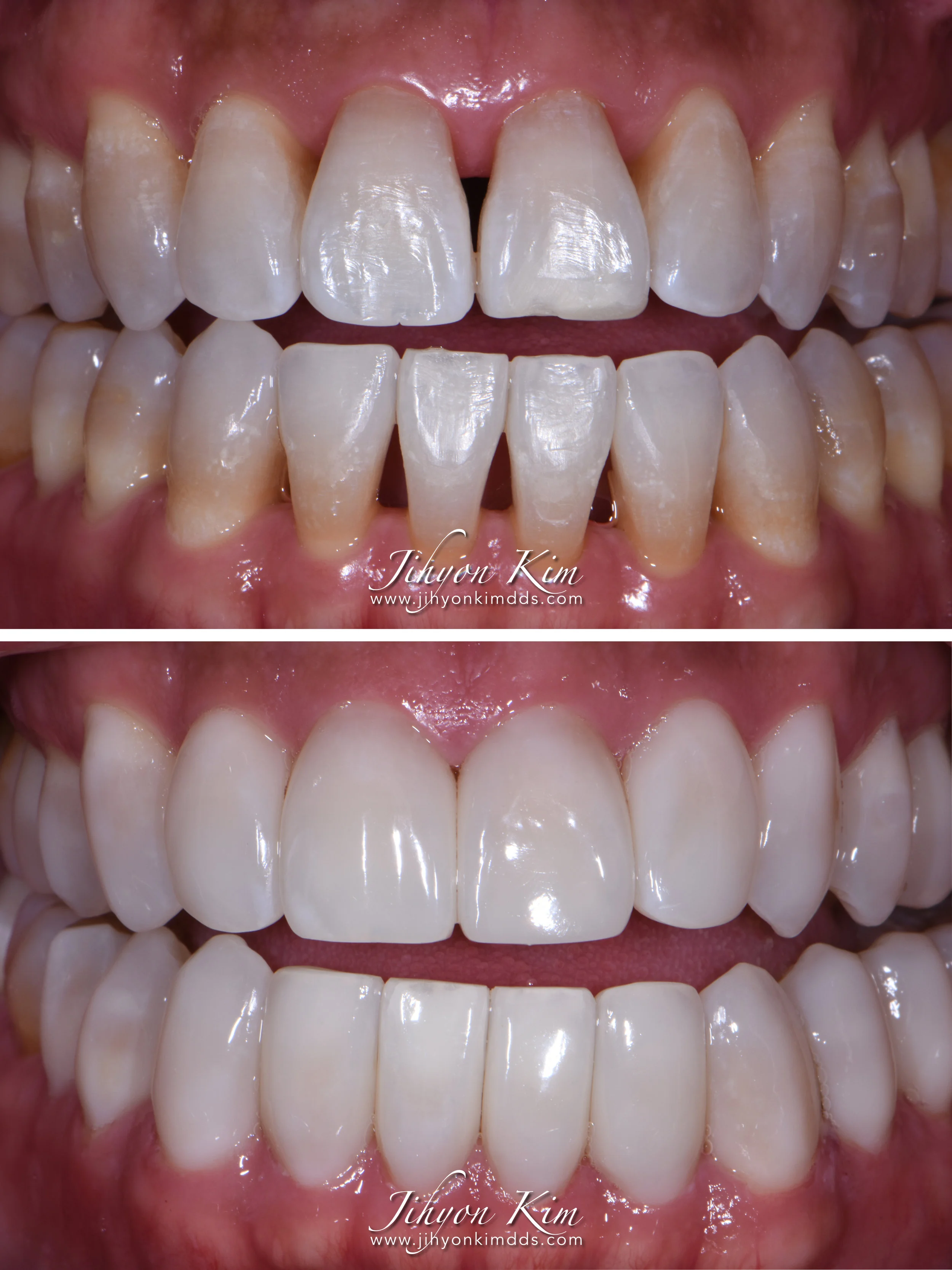 Full Mouth Black Triangle Closure