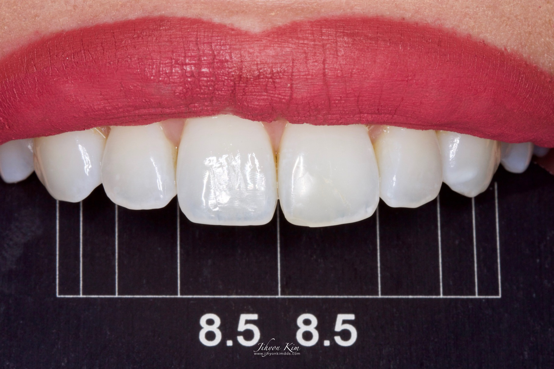 Smile Design Gauge with 8.5mm incisor width grid in use intra-orally.