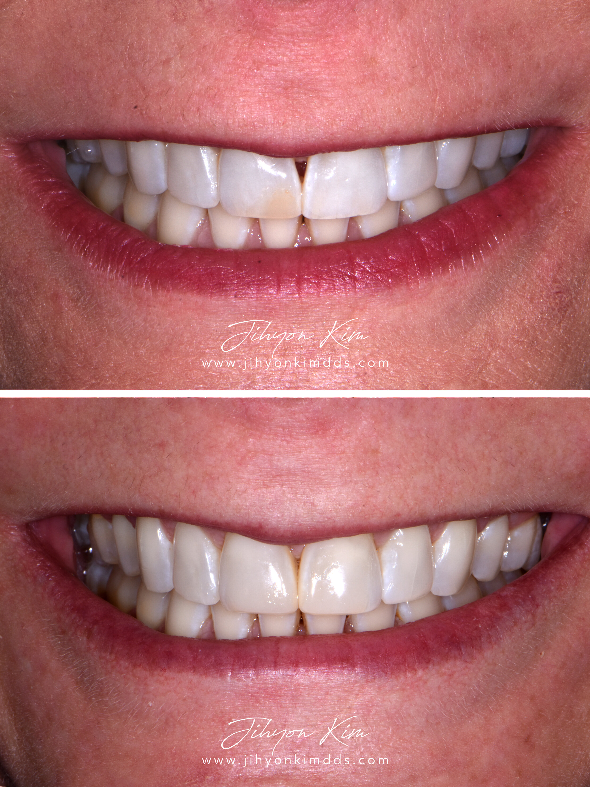 Midline Black Triangle Closure