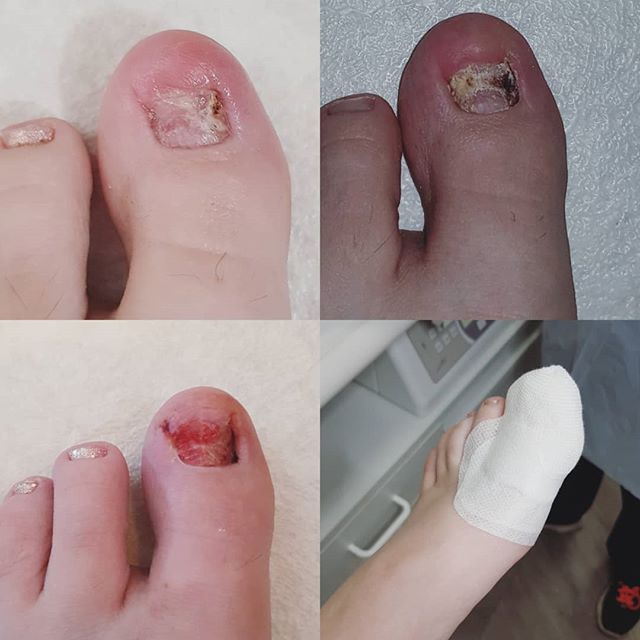 How's that growth coming along since the nail surgery? I hear you say 😋... Well I'm glad you asked. 
Post surgery - first dressing change - January progress and today. 
Slowly growing back in! 
This process of growing a full nail back can take anywh