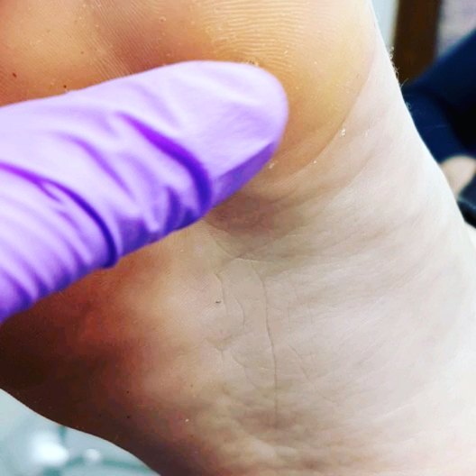 The age old question... &quot;What is this lump on my foot?&quot; 🤔 
While not 100% diagnostic, the Pinch vs Push test is a good starting point. ⁉️ Is this lump painful to pinch? .... it's probably a verruca ⁉️ Is this lump painful to push? ... it's