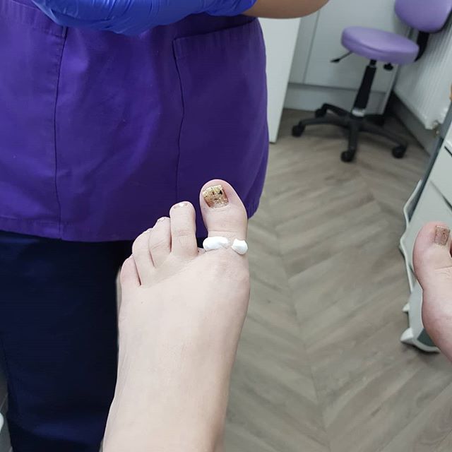 Today was the day that the Podiatrist became the patient 🙈 swipe through to see the journey from nail to nail...less! 
From initial numbing cream application to dignified walk home in flip flops and fur coat 😂 
We offer many different nail surgery 