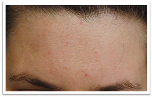 after-3-treats-acne.jpg