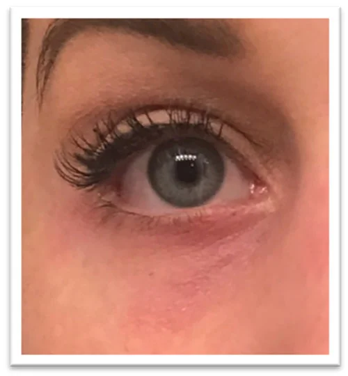 1-treatment-with-Ellipse-IPL-applicator-VL-555-after.jpg