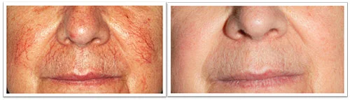 3-treatments--2-with-VL-555-and-1-with-PR-530-applicator-.jpg