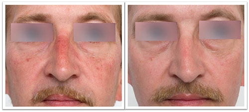 3-treatments-pr-530-facial-telangiectasias.jpg