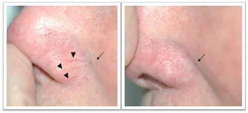 12-weeks-after-treatment-telangiec-.jpg