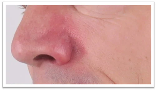 Immediately-after-1-treatment-Ellipse-PR-530-.jpg