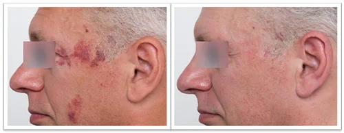 port-wine-stain-3-treatments-pr-530-.jpg