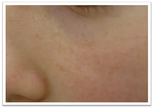1-treatment-with-PR-530-.jpg