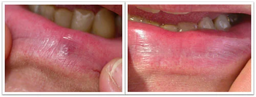 10-weeks-after-1-treatment.jpg