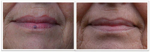 venous-lake-8-weeks-after-1-treat-.jpg