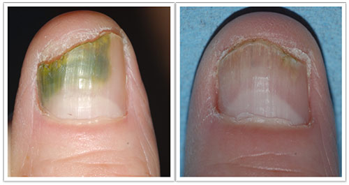 Case 1. Coinfection with P. aeruginosa and C. parapsilosis.... | Download  Scientific Diagram