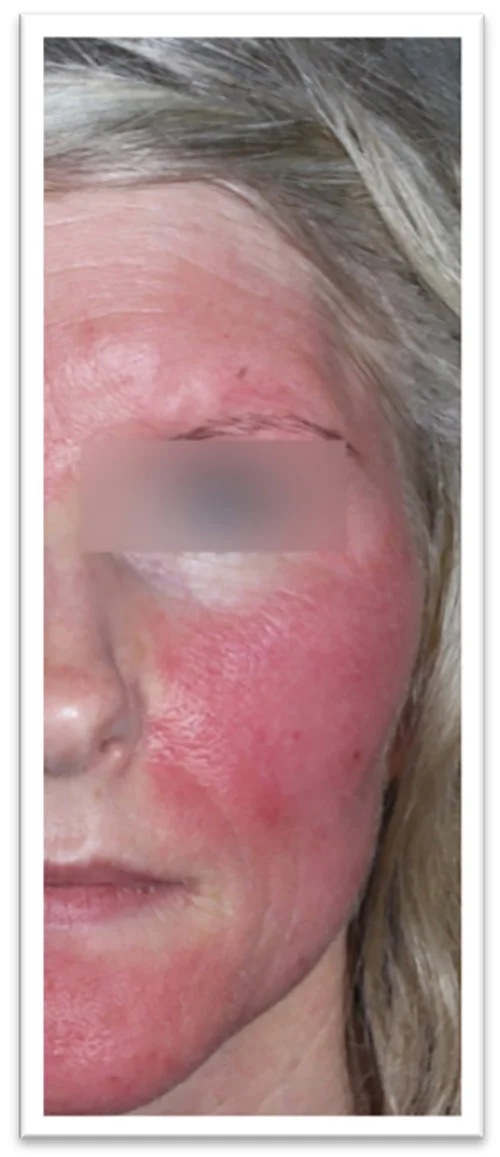 Sun Damaged skin treatment — Shirley's Beauty Clinic