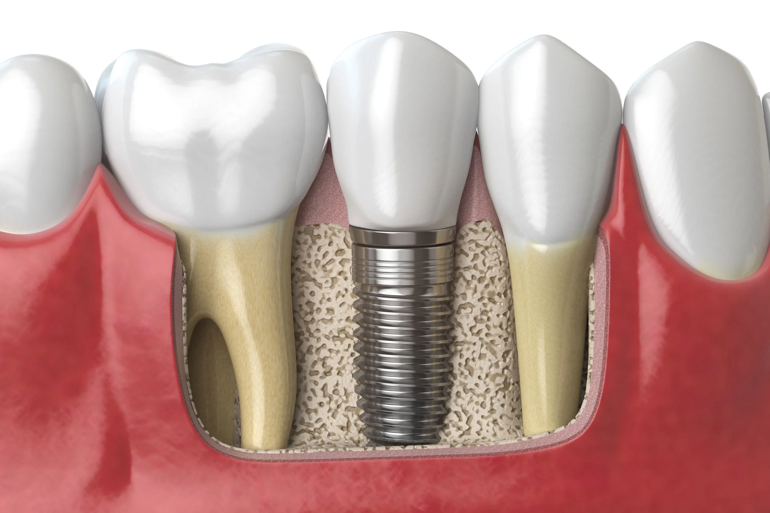 bone_grafting.jpg