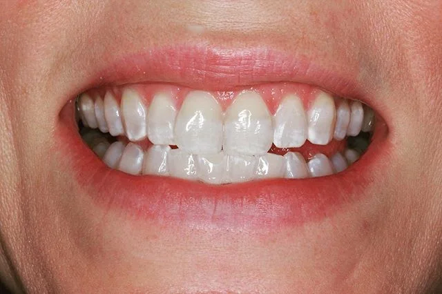 Nice little #glowup for this beautiful mama just in time for the weekend ✨✨✨. . . Achieved with only a 45 minute #philipszoomwhitening in-chair treatment! Call now to book 0733792253