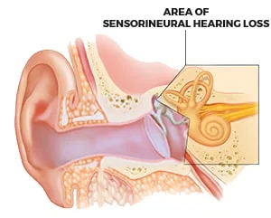 Hearing Loss — High Point Audiological