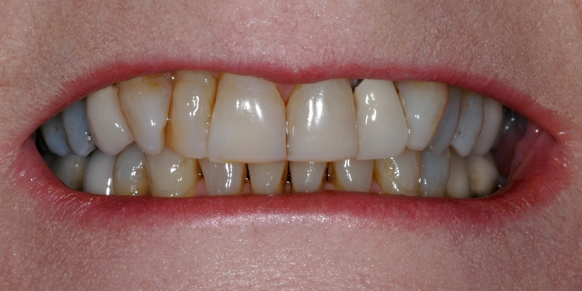 composite_veneers_before.jpg