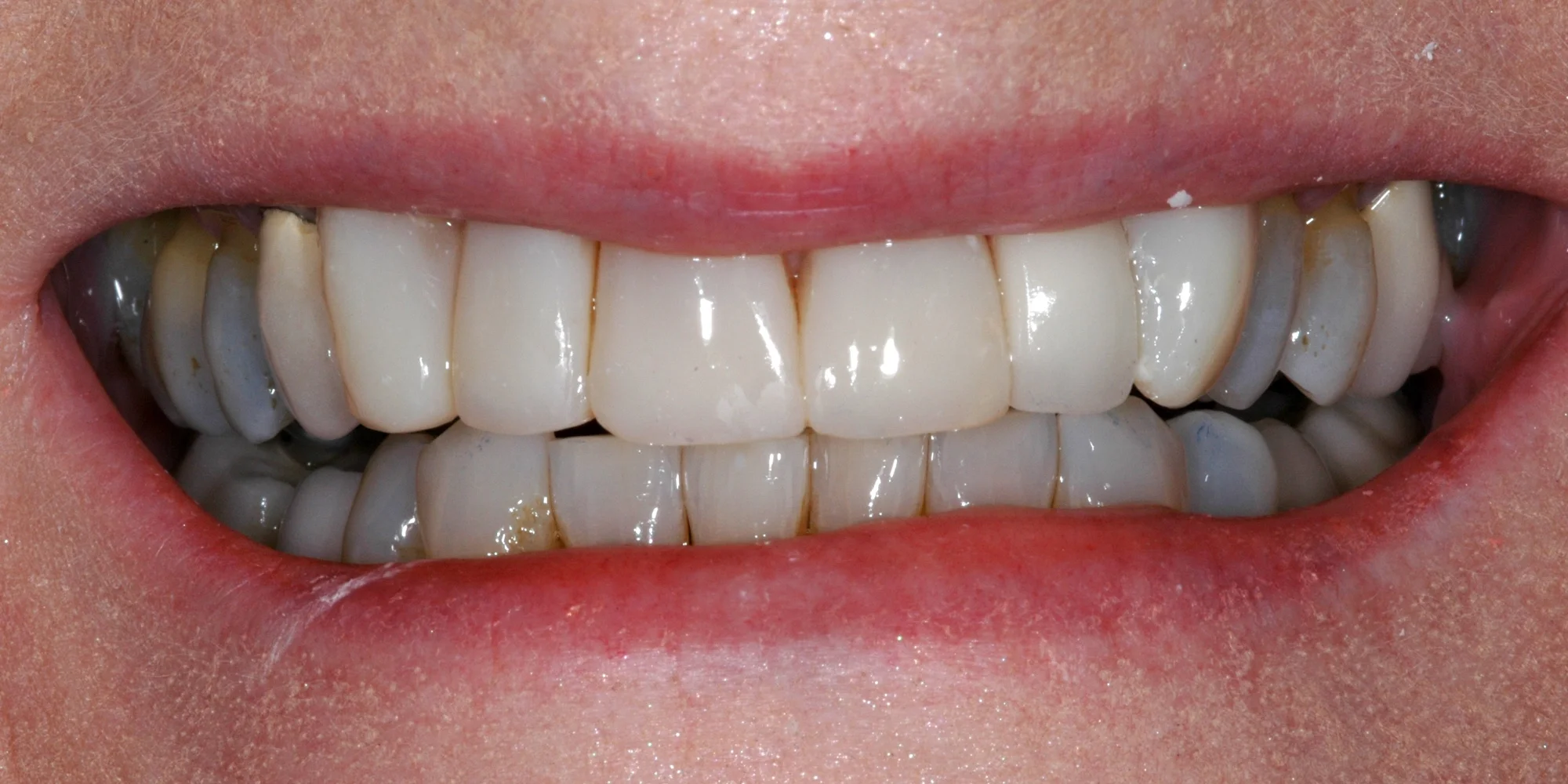 composite_veneers_after.jpg