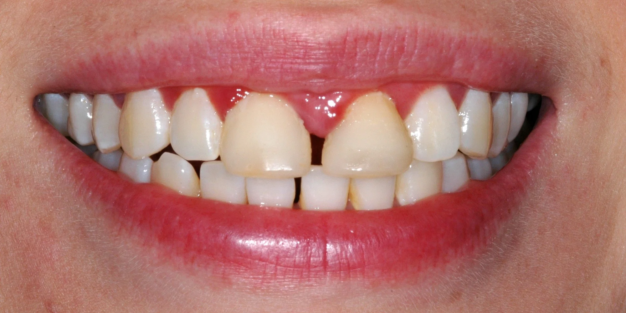 porcelain_veneers_before.jpg