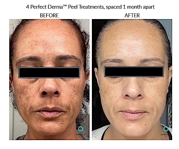 Perfect peel pigment.jpeg