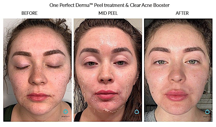 perfect peel acne 3pics.jpeg