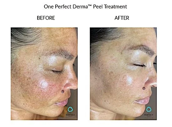 Perfect derma peel pigment.jpeg