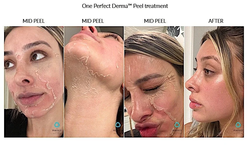 Perfect ferma peel 4.jpeg