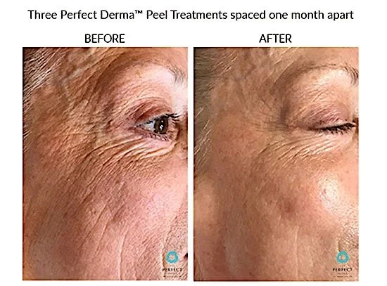Perfect derma peel age.jpeg