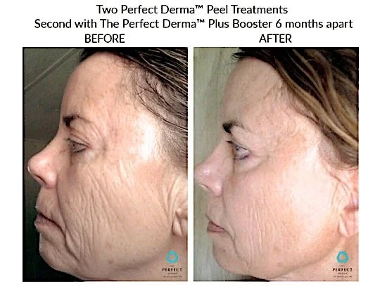 Perfect derma peel age 2.jpeg