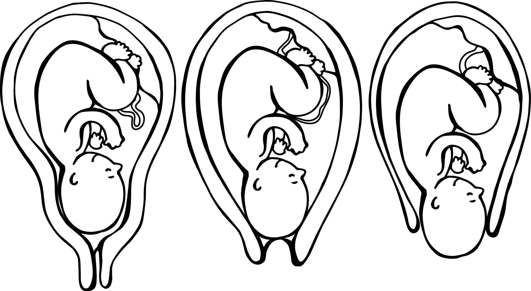 Cervical Ripening and Dilation .png