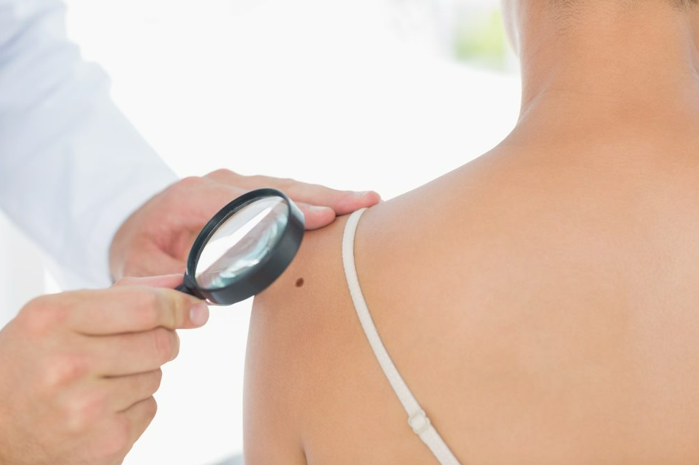 How To Detect Melanoma Early On
