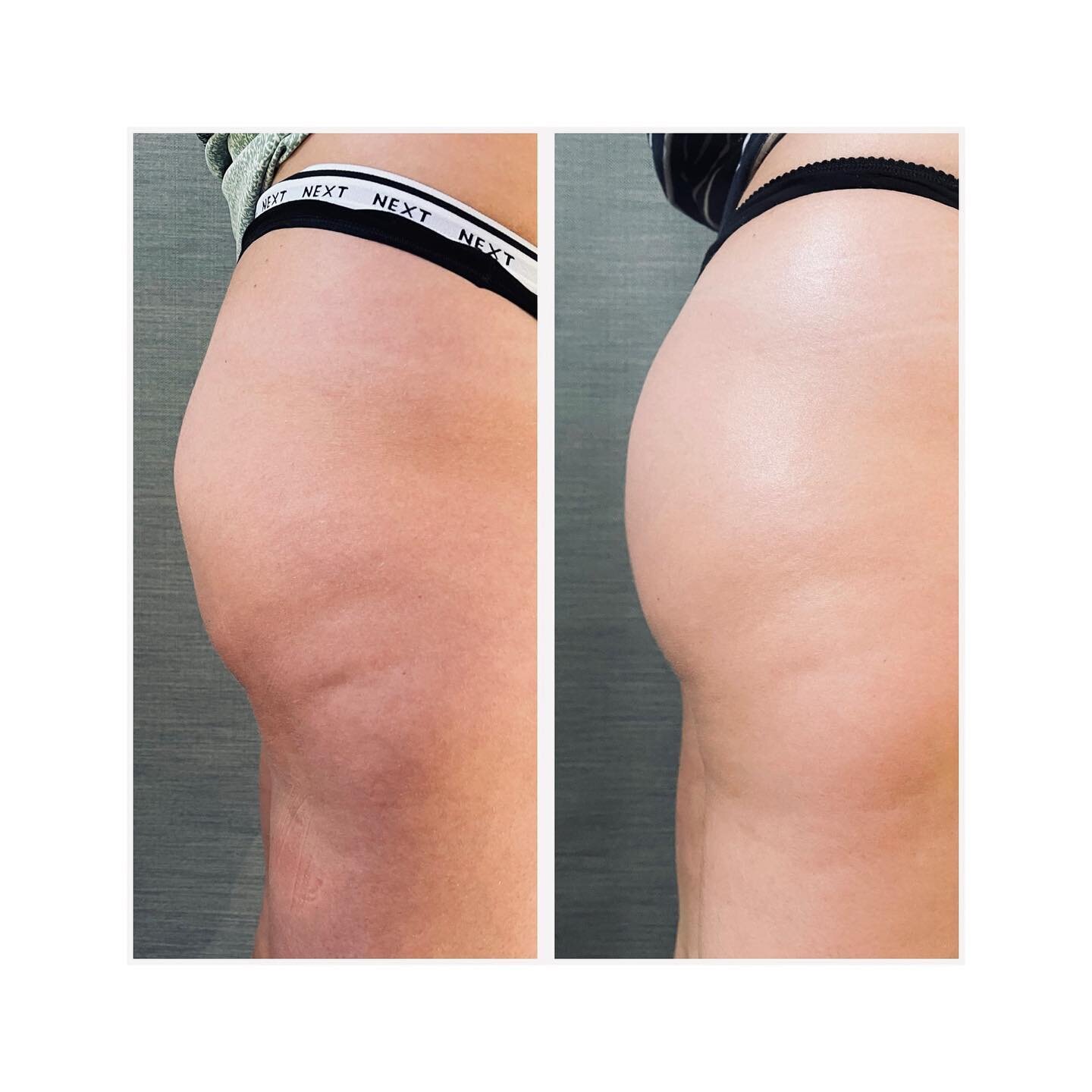 A nice little bum lift 🍑 
You can see how the skin is tighter, smoother and the shape is lifted. 
This was achieved after only 4 treatments. 
There&rsquo;s still time to get your body ready for the beach 👙 

To book please contact me for a free con