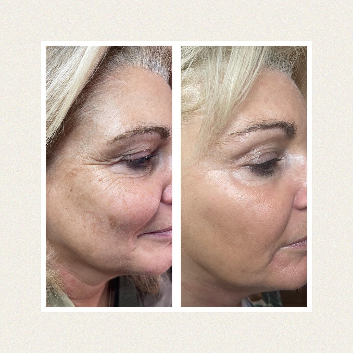 An amazing result using @obagimedical NuDerm system to treat pigmentation and signs of ageing. 
Her skin is smoother, glowing and clear from pigmentation.
This took 14 weeks using prescription skincare at home with my guidance. 
Book a free consultat