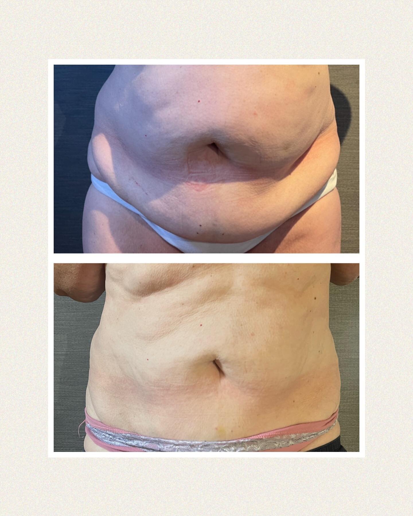 An amazing result using my Cryolipolysis machine to remove stubborn areas of fat. 
This was after two sessions and I can safely say my client is thrilled. She&rsquo;s already deciding where to treat next 😊 

To see if this treatment is suitable for 
