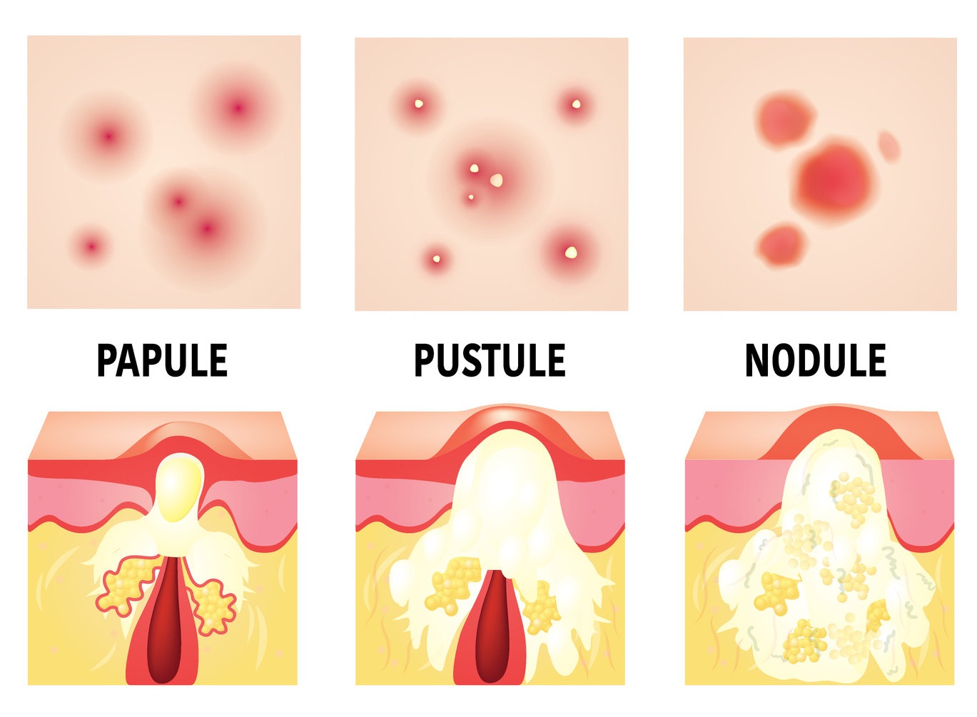 acne nodule vs cyst